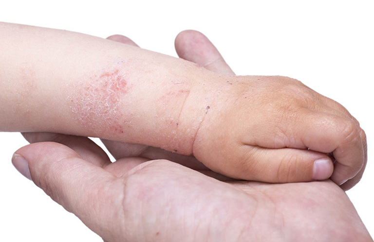 cơ địa dị ứng, viêm da cơ địa của trẻ em