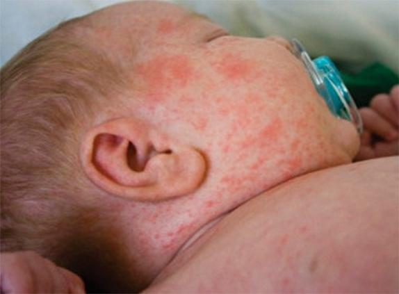 trẻ em bị viêm da dị ứng, trung tâm chăm sóc sức khỏe Mandala Care, điều trị không dùng thuốc, không dùng kháng sinh