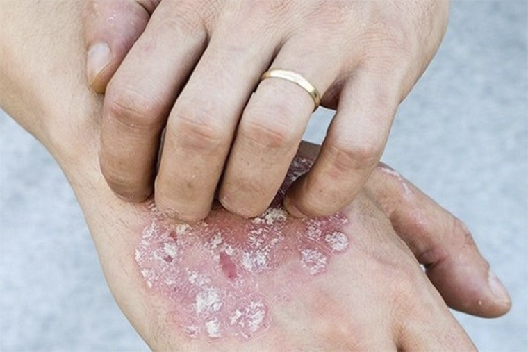 trẻ em bị viêm da dị ứng, trung tâm chăm sóc sức khỏe Mandala Care, điều trị không dùng thuốc, không dùng kháng sinh