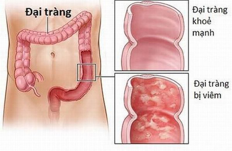 điều trị viêm đại tràng tại trung tâm chăm sóc sức khỏe Mandala Care