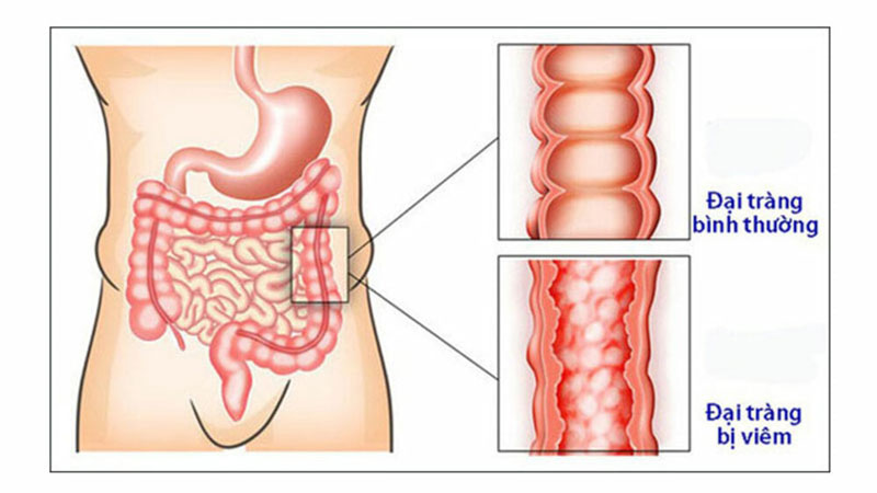 điều trị viêm đại tràng tại trung tâm chăm sóc sức khỏe Mandala Care