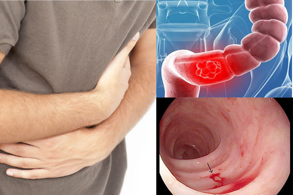 điều trị viêm đại tràng tại trung tâm chăm sóc sức khỏe Mandala Care