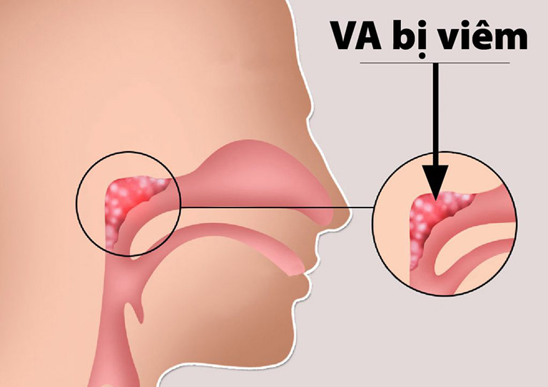 điều trị viêm VA cấp tính cho trẻ em tại trung tâm chăm sóc sức khỏe Mandala Care