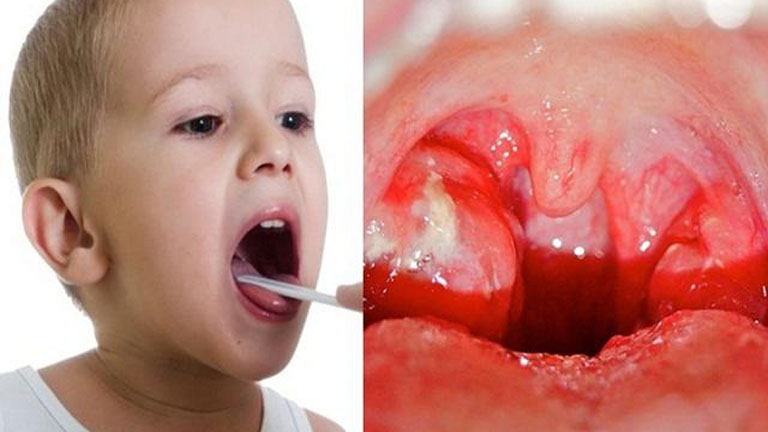 điều trị viêm Amidan cấp tính cho trẻ em tại trung tâm chăm sóc sức khỏe mandala Care