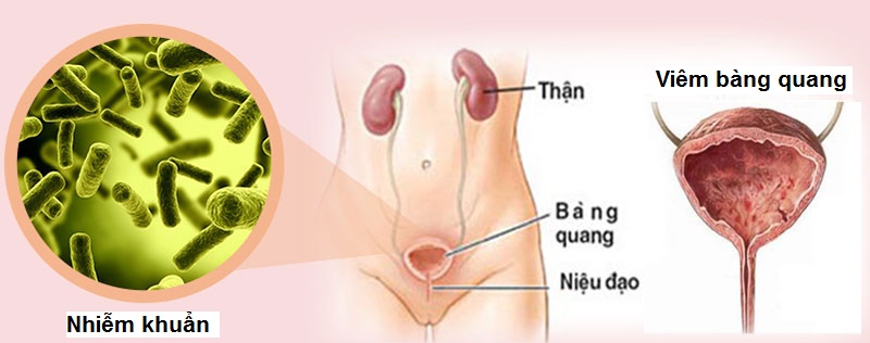 điều trị viêm bàng quang nam nữa tại trung tâm chăm sóc sức khỏe Mandala Care