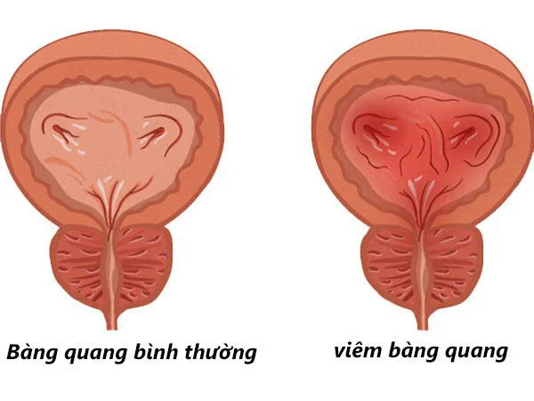 điều trị viêm bàng quang nam nữa tại trung tâm chăm sóc sức khỏe Mandala Care